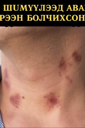 Хүзүү нь шимүүлээд авах юмгүй улаан эрээн болчихсон байсан